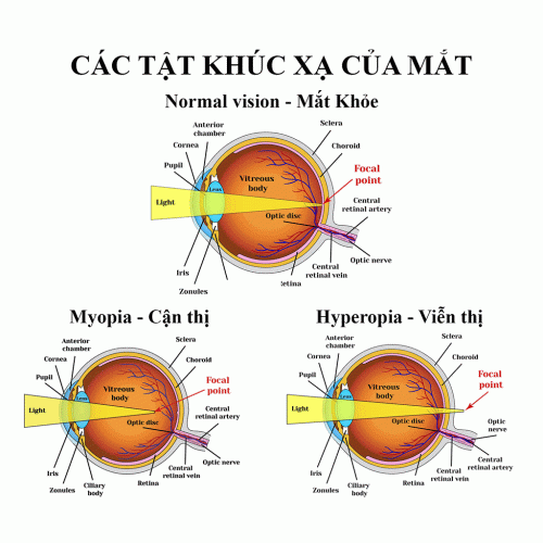 CÁC TẬT KHÚC XẠ & GIẢI PHÁP